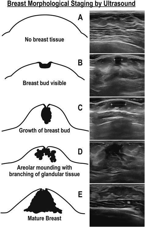 teen perky breasts|Breast Development During Puberty: Stages and Symptoms